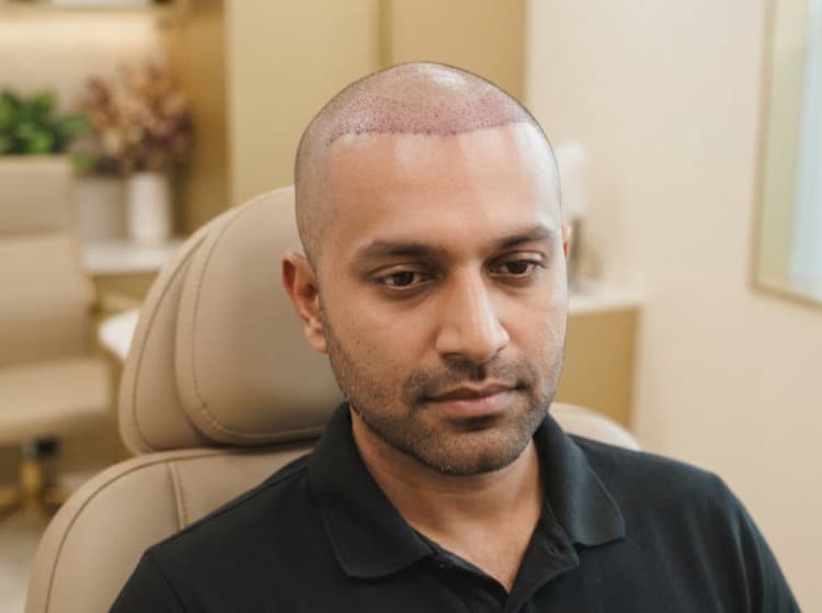 Hair Transplant